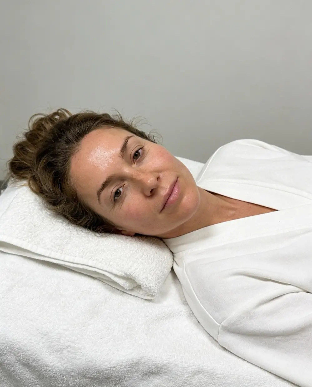 Seidenglanz Ergebnis — verfeinertes Hautbild nach Microneedling